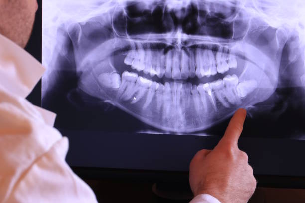 Best Emergency Wisdom Tooth Extraction in Kearney Park, MS